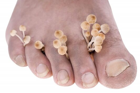 Fungus on my toes