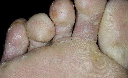 Toe fungus