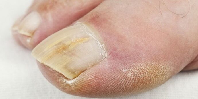 Symptoms of onychomycosis