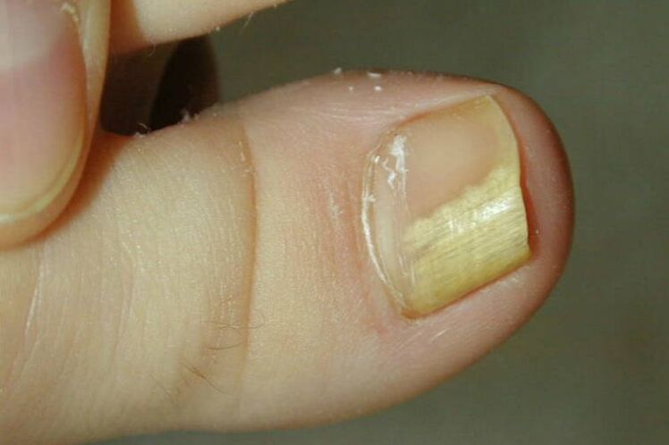Big toe fungus symptoms photo 1