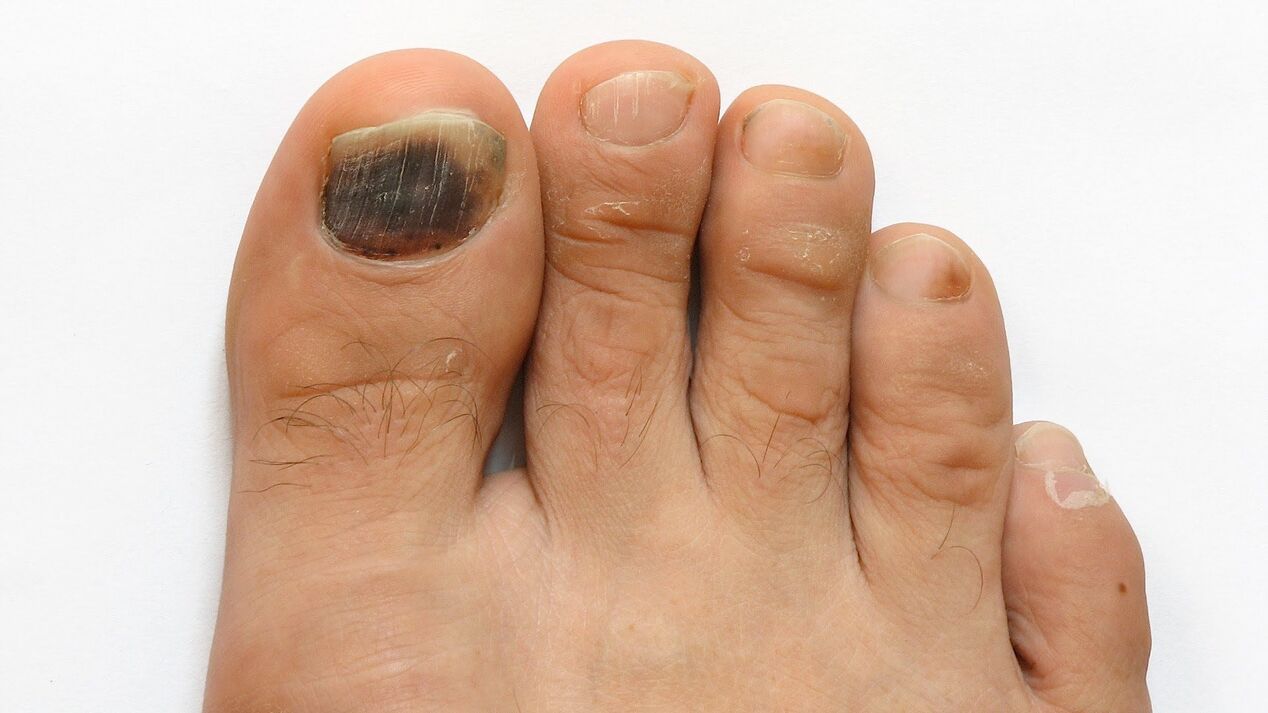 Big toe fungus symptoms photo 2