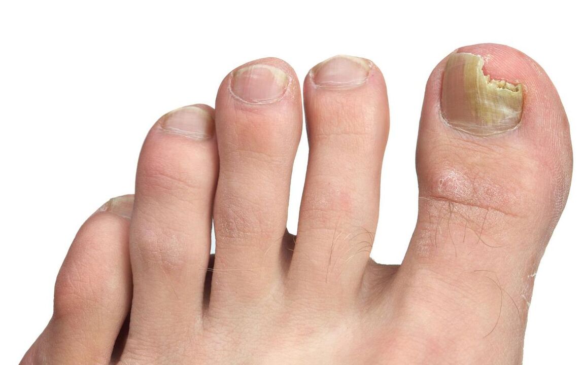 Big toe fungus symptoms photo 3