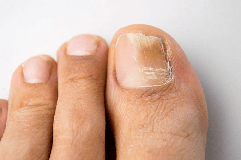 Big toe fungus symptoms photo 4