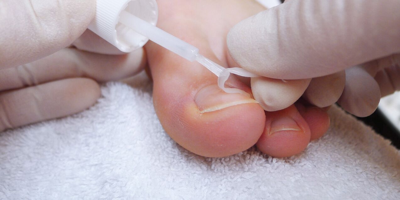 Medicinal varnish against onychomycosis