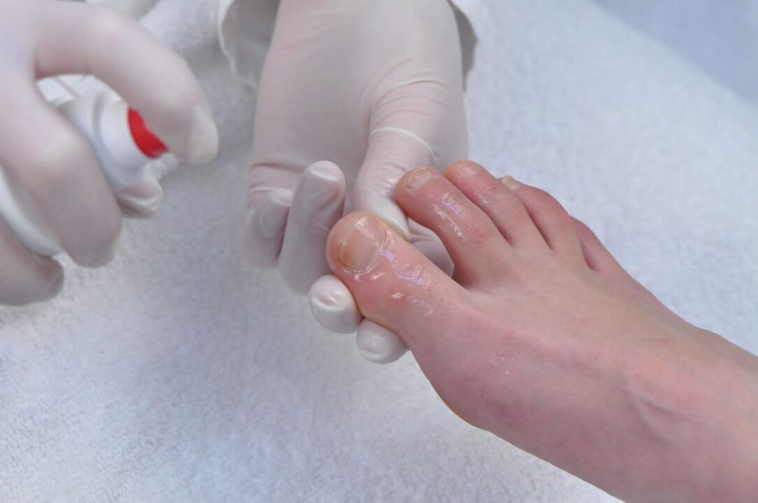 Spray to treat onychomycosis