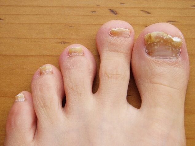 Damage the nail plate with fungus