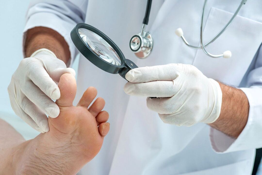 Doctor examining foot with fungus
