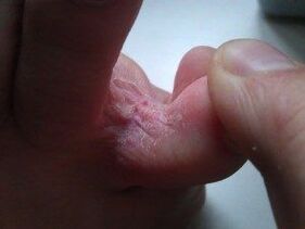 fungal skin lesions between the toes