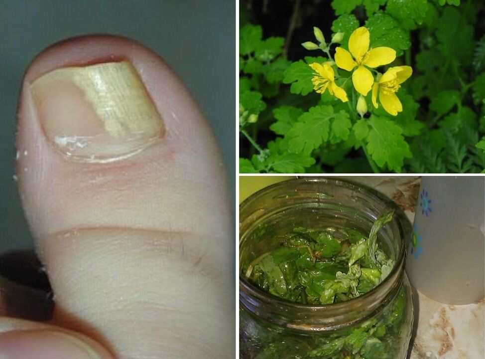 Celandine treats toenail fungus