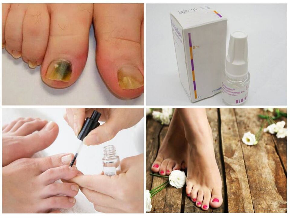 How to Use Polish to Fight Nail Fungus