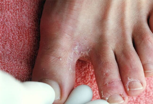 Symptoms of inter-toe fungus