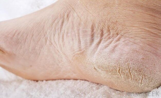 Dry feet are a sign of fungus