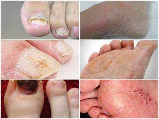 What does fungal disease on the legs look like 