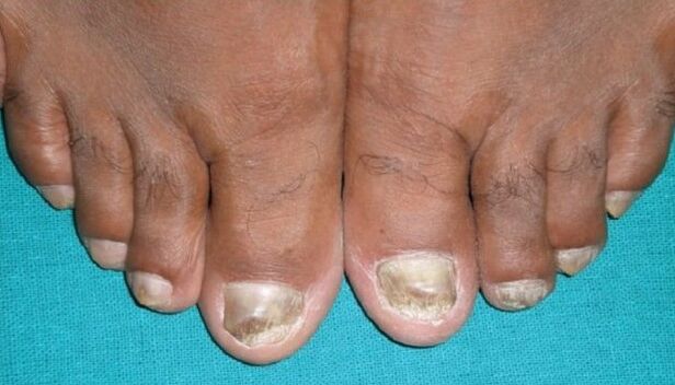 Fungus on nails