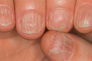 Fungal lesions
