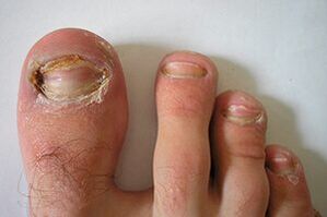 Fungus on nails