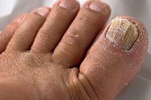 Photos of nail fungus