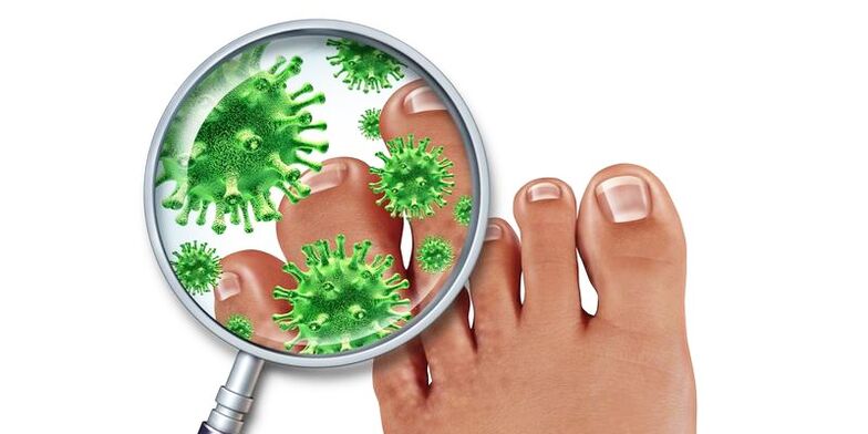 Nails are infected with fungi