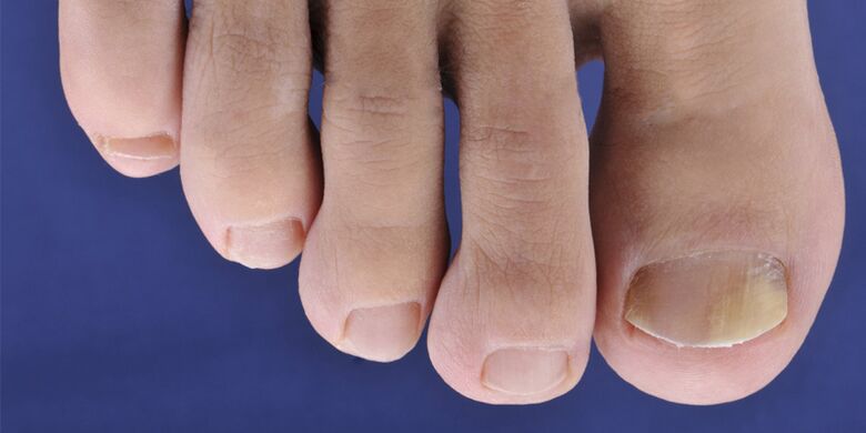 Symptoms of skin mycotic diseases and nail plates