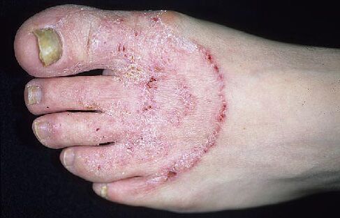 Foot and nail fungi