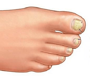 Streptomycesiasis
