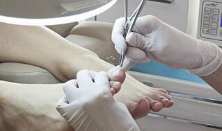 Surgery to remove nails in the presence of fungi
