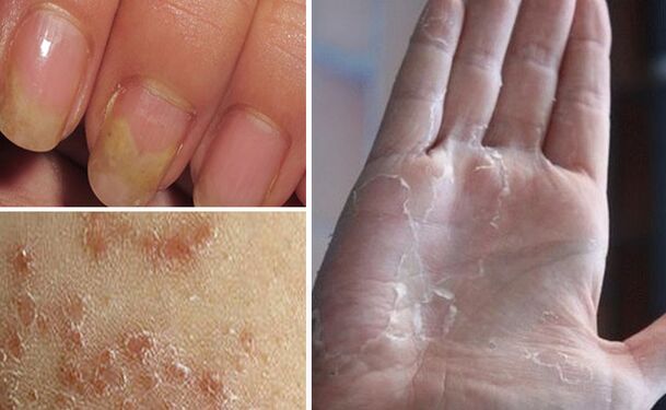Can fungal diseases be switched to other parts of the body
