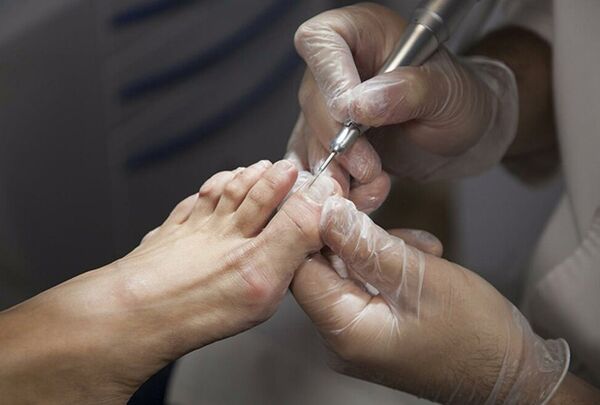 Diagnosing leg fungi