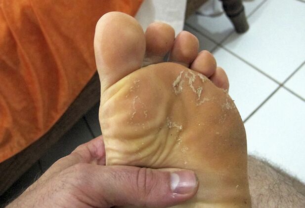 Fungus on the skin of the legs