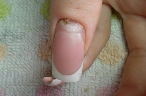 Symptoms of onychomycosis
