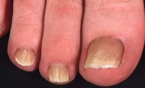Types of toenail fungus