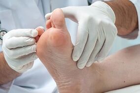 Doctor checks toe for fungus