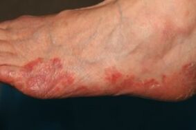 Symptoms of fungus on feet