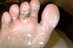 fungus on fingers and feet