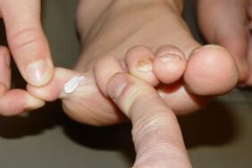 fungus on toes