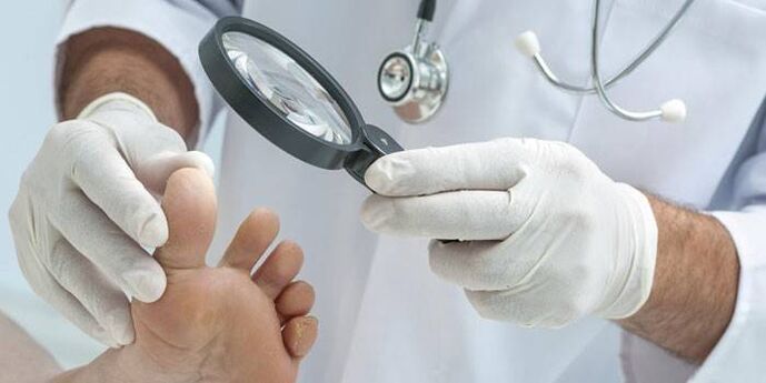How to Treat Fungus