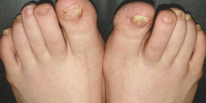 What is onychomycosis