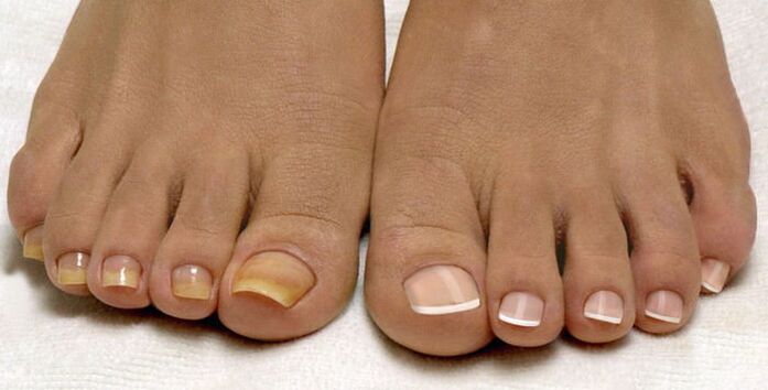 Healthy toenails and nails are infected with fungus