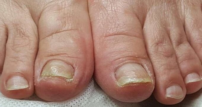 Fungus on the feet damages the nails