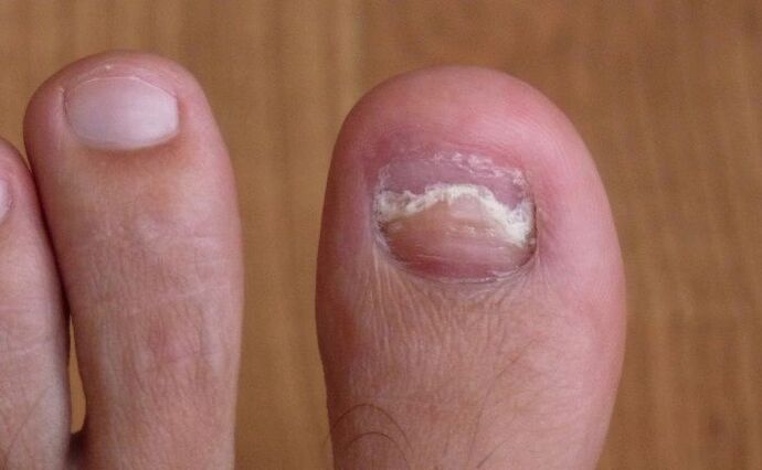 Damage the nail on the big toe with fungus