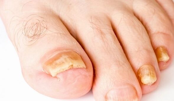 Fungal infection of yellow toenails