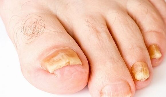 Photos of toenail fungus symptoms