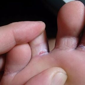 Cracks between the toes with fungal symptoms
